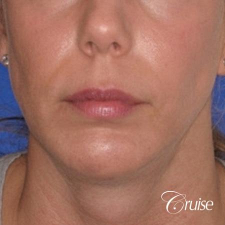 best medium anatomic chin implant on female - After Image 1