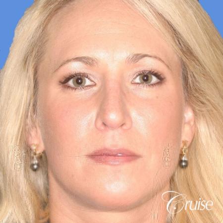 female with natural looking chin implant - After Image 1