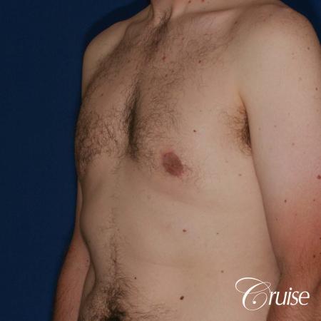 adult male with moderate gynecomastia gets donut lift - After Image 3