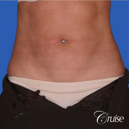 best lipo photos of love handles and stomach - After Image 1