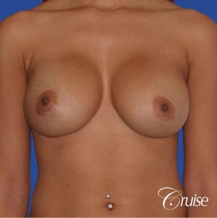 best pictures of ruptured implant breast revision - After Image 1