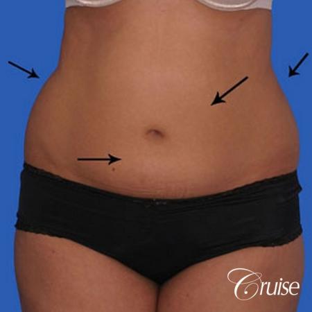 small waist with liposuction abdomen and flanks - Before Image