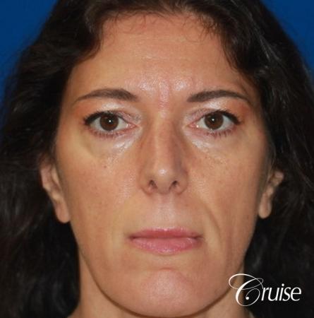 Fat Transfer - Forehead, Temple, Tear Trough, Lower Lids, Cheeks - Before Image