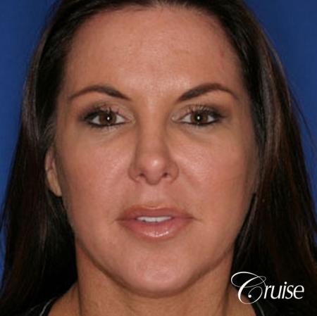 Fat Transfer - Temple, Tear Trough, Lower Lids, Cheeks - After Image