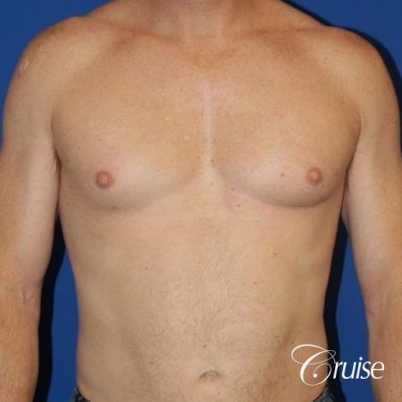 best gynecomastia results on 45 year old - Before Image 1
