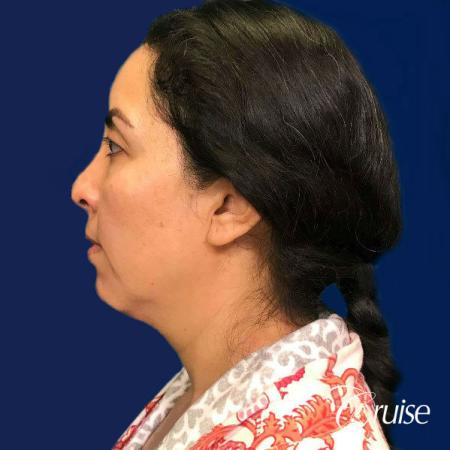 Liposuction of Neck/Jawline - Before Image 2