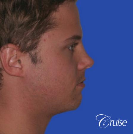 young male with best chin augmentation - Before and After Image 2