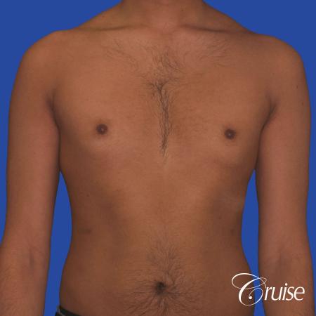 best before and after results for gynecomastia surgery - Before 1