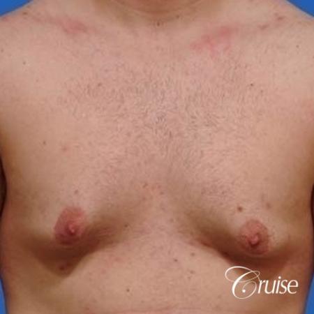 mild gynecomastia with puffy nipple on adult - Before Image 1