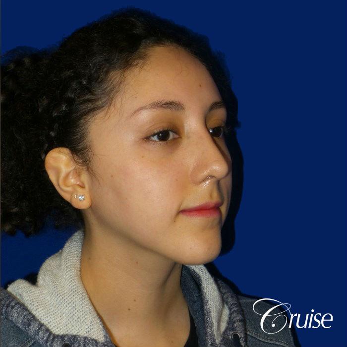 Rhinoplasty - After 2