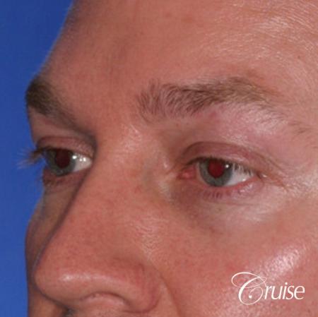 male soft tissue filler Juvaderm - After Image 2