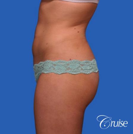 best liposuction results on abdomen, flanks, thighs - After Image 3