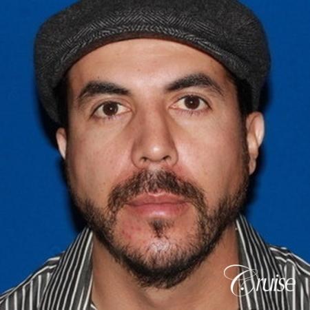male patient with large chin augmentation - After Image 1
