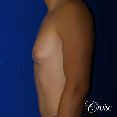Mild Gynecomastia -Areola Incision - Before Image 3