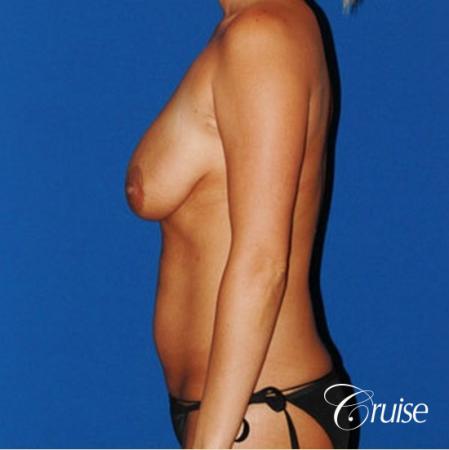 tummy tuck and saline breast lift with large implants on mommy makeover - Before Image 2