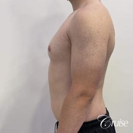 Gynecomastia: Patient 123 - Before 3
