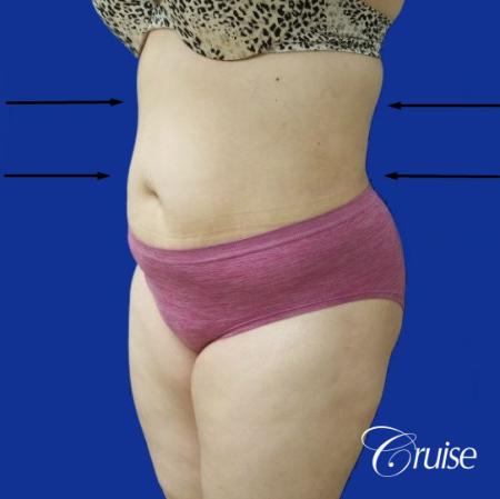 Best liposuction procedures dr cruise - After Image 3