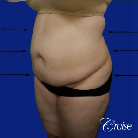 Best liposuction procedures dr cruise - Before Image 3