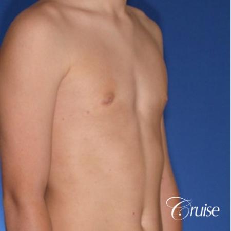 teenage gynecomastia with puffy nipple - After 3