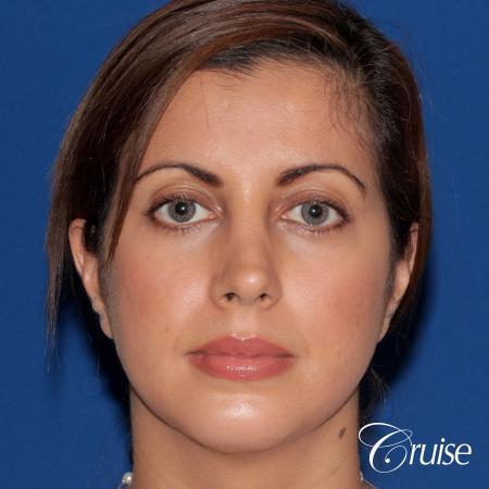woman with large anatomic chin implant - After Image 1