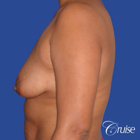 best breast lift donut with saline augmentation - Before and After Image 2
