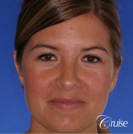 best otoplasty on adolescent - After Image 1