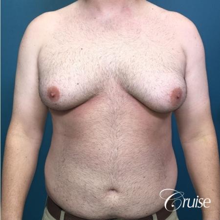 Severe Gynecomastia- Free nipple Graft - Before Image 1