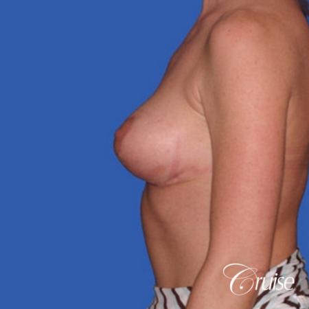 no implants with breast lift anchor - After Image 2