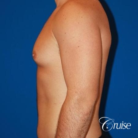 athletic adult with puffy nipple - Before Image 2
