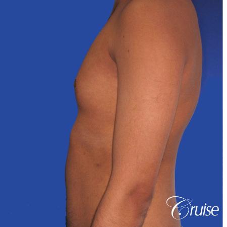best before and after results for gynecomastia surgery - Before 2