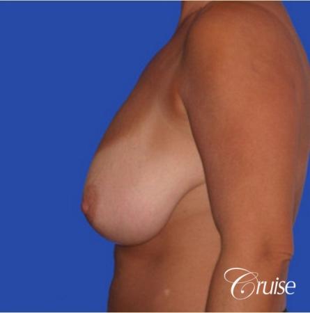 best pictures of breast lift anchor on 38 yr old mother - Before and After Image 2