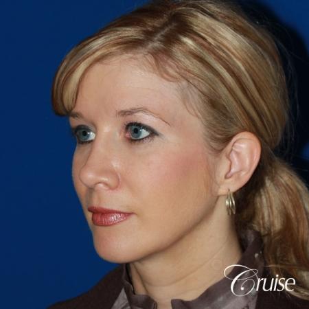 female patient with best chin implant scar - After Image 3
