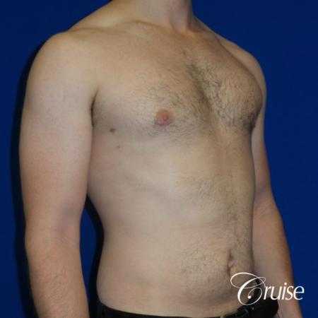 Adult gynecomastia before and after photos - After Image 2