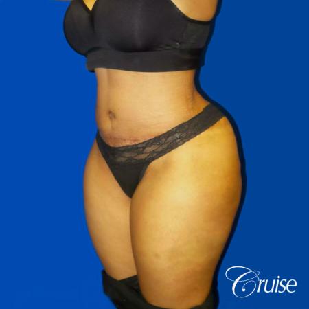 Best Tummy Tuck surgeons Newport Beach - After Image 2