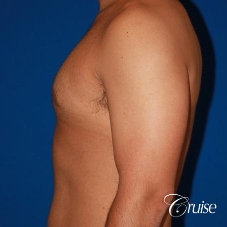moderate gynecomastia on adult - After 2