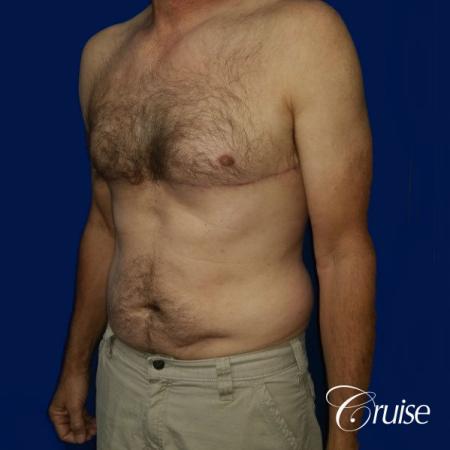 Moderate Gynecomastia Pedicle - After Image 3