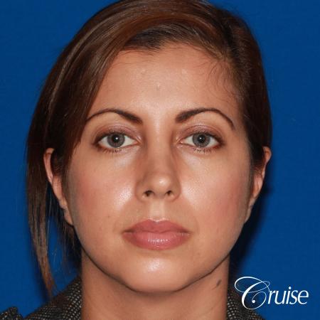 woman with large anatomic chin implant - Before Image 1