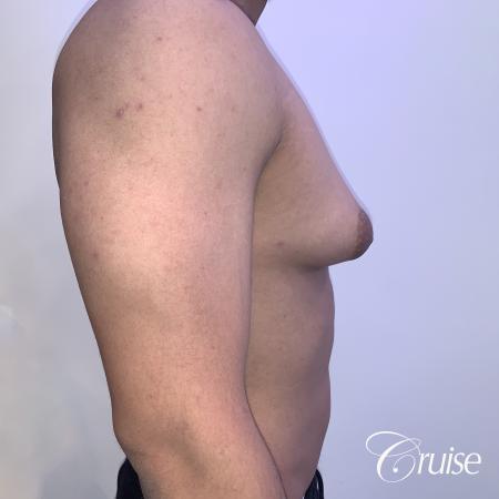 gynecomastia surgery - Before 4