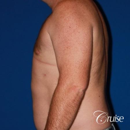 mild puffy nipple on 42 year old - After Image 2
