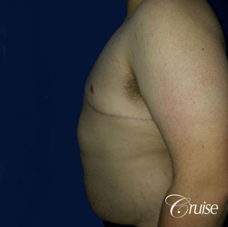 male breast reduction surgery orange county - After 2