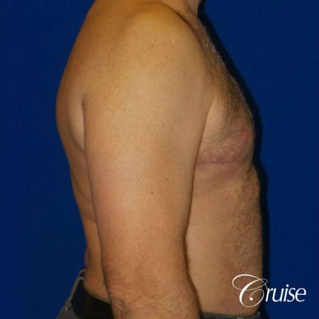 Severe Gynecomastia Correction - After 3