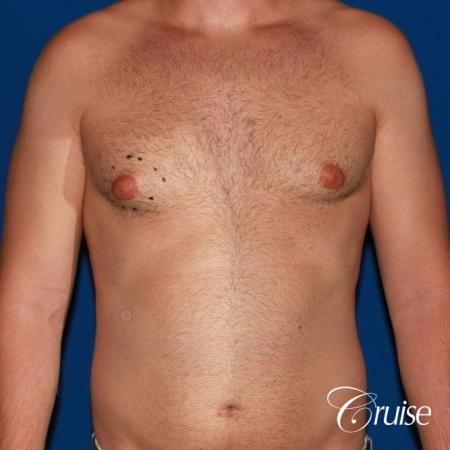 best puffy nipple surgery correction - Before Image 1