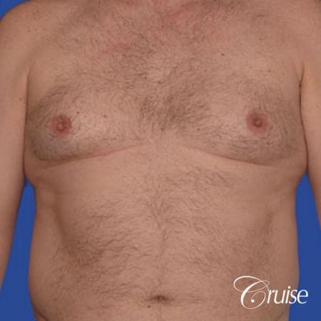 chest liposuction on adult - Before Image 1