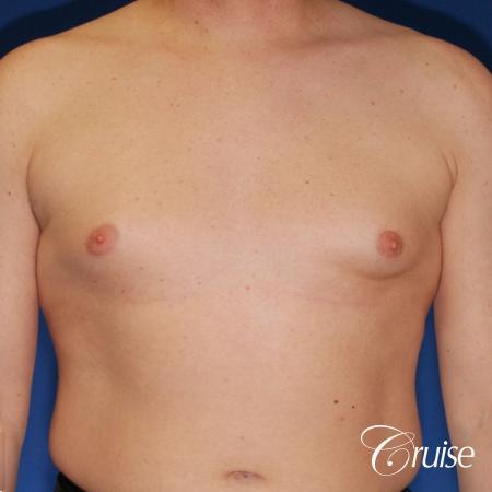 moderate gynecomastia on adult with donut lift scar - Before Image 1