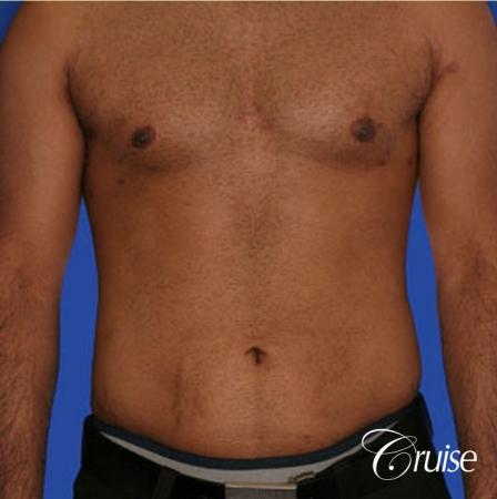 best liposuction abdomen and flanks on a male patient - After Image