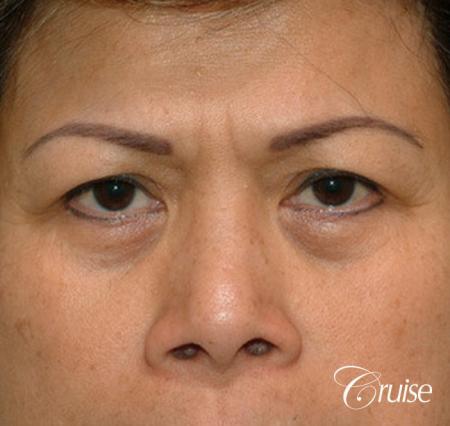 best Asian Upper eye lid plastic surgeon Newport Beach - Before Image 1