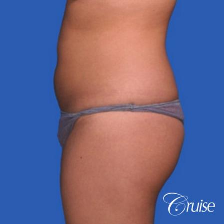 best before and after liposuction stomach and love handles - Before and After Image 2