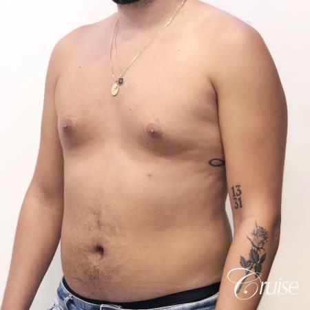 gynecomastia correction orange county - Before Image 3