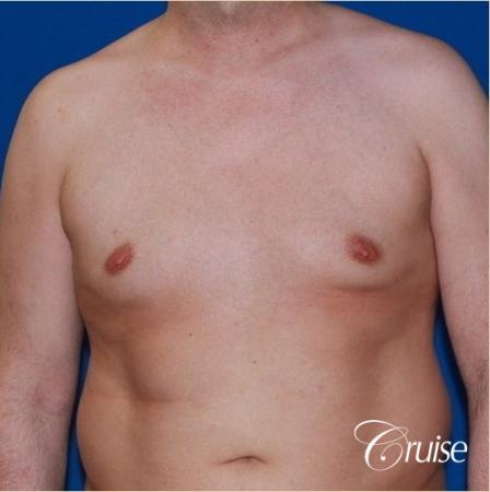 Free Nipple Graft male gynecomastia - Before Image 1