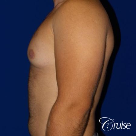 best gynecomastia results - Before Image 3